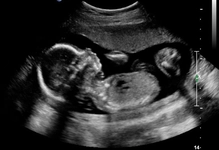 20 Haftalık Gebelik