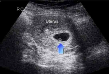 4 Haftalık Gebelikte Annede ve Bebekte Yaşanan Değişimler